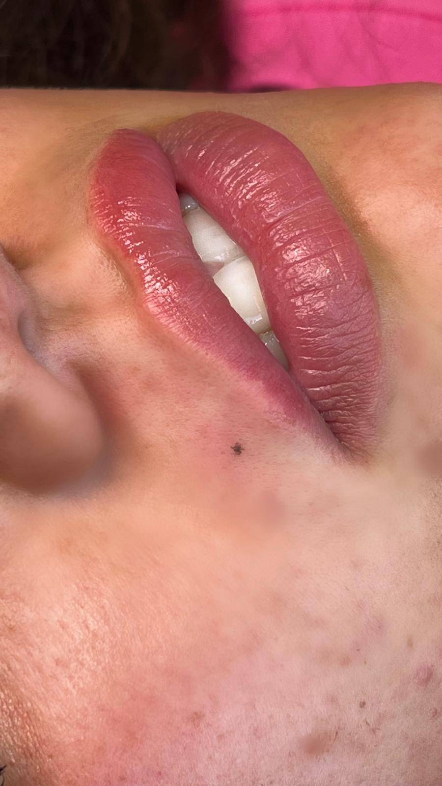 genezen resultaat lipblush